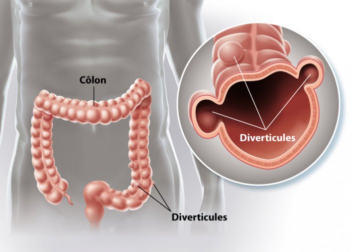 Diverticules du colon | Clinique Saint-Amé